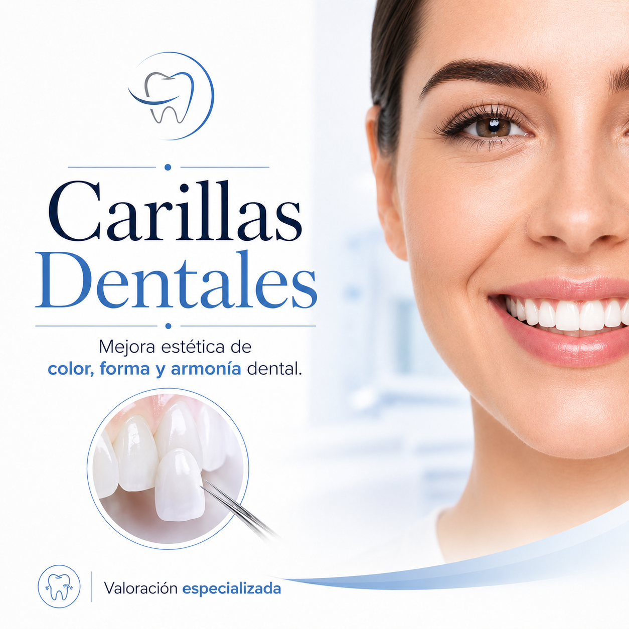 Carillas dentales