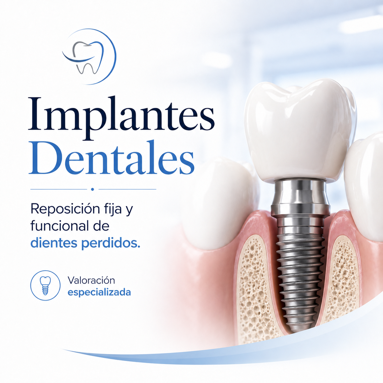 Implantes dentales